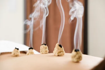 Moxibustion